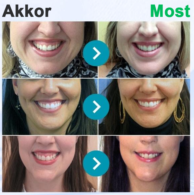 🦷 Οδοντόκρεμα με δηλητήριο μέλισσας -Φροντίστε τα δόντια σας φυσικά με τη δύναμη της μέλισσας!🐝✨